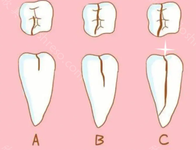 牙齿会裂开两半怎么办？牙齿裂开后的处理方法
