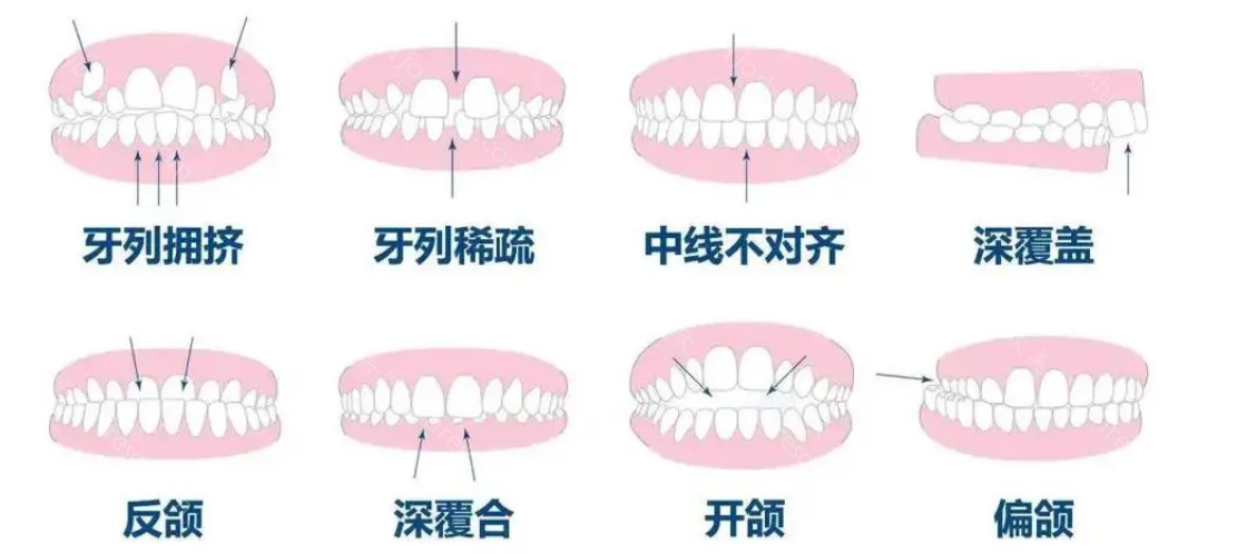 牙齿正确的咬合图片，了解正确的咬合方式