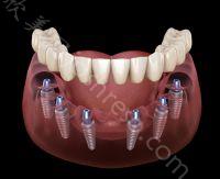 上海德雅口腔门诊部种植牙收费价格表公开：单颗/半口/全口都有！