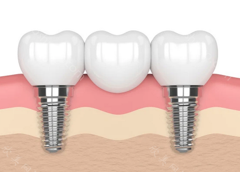 口腔全口种植的费用?种植一颗牙齿-全口种植的价格都在这