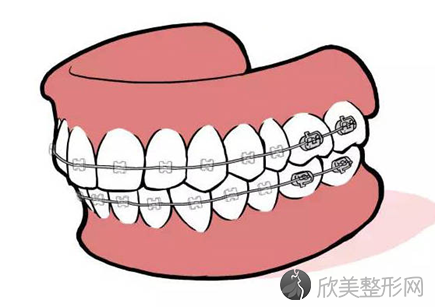 儿童口腔正畸戴哪个？儿童矫正这些事家长一定要知道