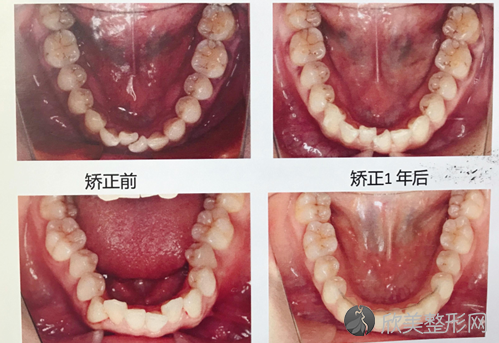 儿童口腔正畸戴哪个？儿童矫正这些事家长一定要知道