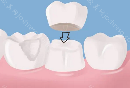 玻璃陶瓷和氧化锆全瓷的区别?牙医告诉你真正的答案!