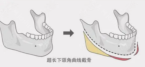 潘宝华下颌角怎么样?下颌角风格自然,是位好医生!