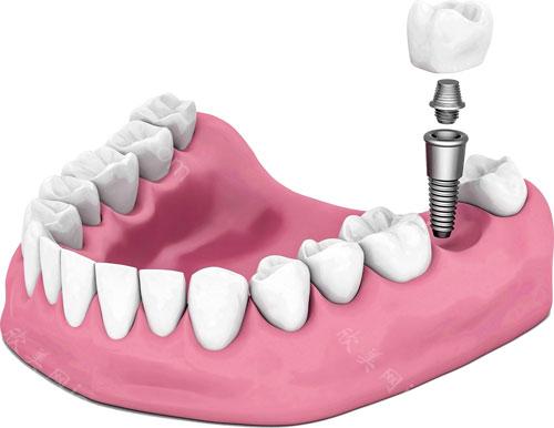 成都极光口腔医院种植牙价格，牙齿种植集采后4200起