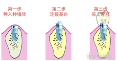 种牙的程序及时间图解?想种牙不可不知的细节都在这里