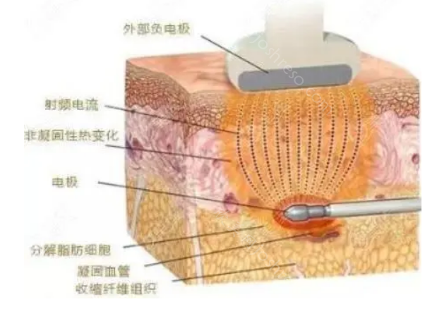 深圳阳光整形医院热玛吉怎么样?正规医美授权，抗衰美肤选它没错!