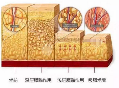 吸脂减肥价格多少?吸脂减肥费用成因解析,吸脂相关科普