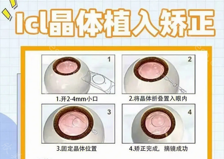 普瑞眼科医院全飞秒价格?半飞秒/个性飞秒/晶体植入价格全曝光