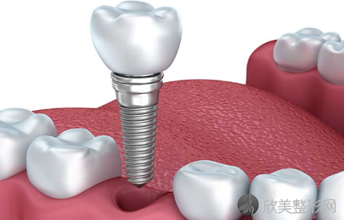 永康市哪个医院做种植牙好？附种植牙2023年价格表