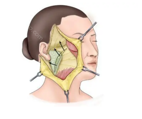 广州南方医院拉皮手术怎么样?多少恰?费用明细，医生介绍!