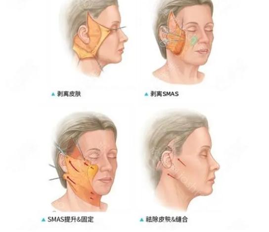 南宁东方医疗赵波拉皮怎么样?赵医生技术好，拉皮价格亲民!