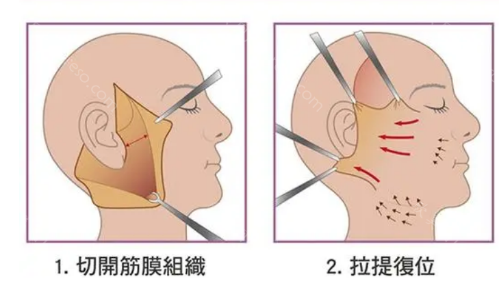 杭州丽脂拉皮怎么样?拉皮技术特色+口碑医生介绍！