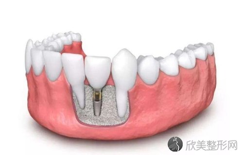 玉林蓝天口腔种植牙技术可靠吗？顾客点评口碑都不错