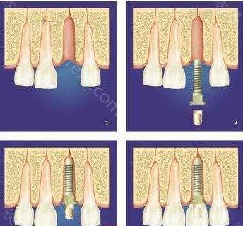 青岛瑞泰口腔收费价格是多少?价格表参考，附多项价格!