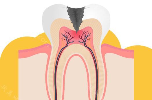 二次根管治疗要慎重?查看项目介绍/相关科普来了