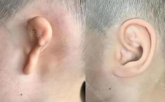 做小耳畸形手术能报销吗?