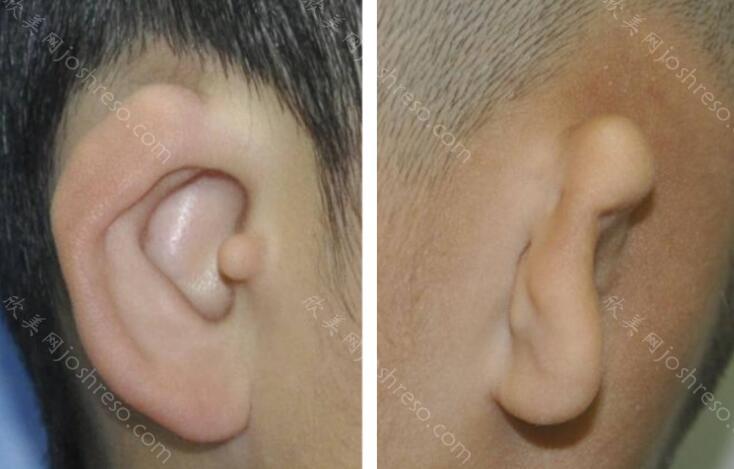 做小耳畸形矫正具体的风险有哪些