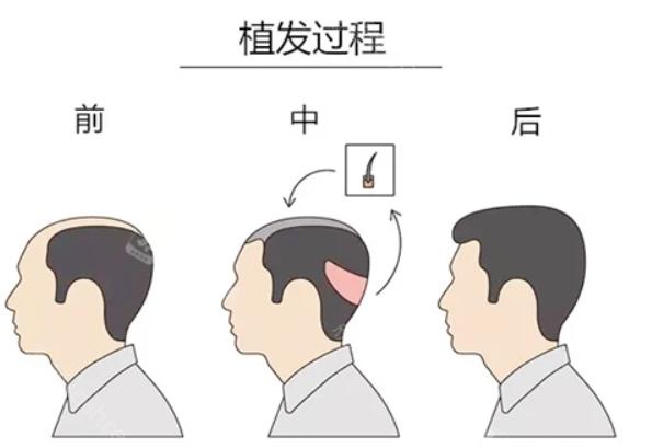 福州海峡植发医院收费贵吗?可参考发际线种植跟眉毛种植费用