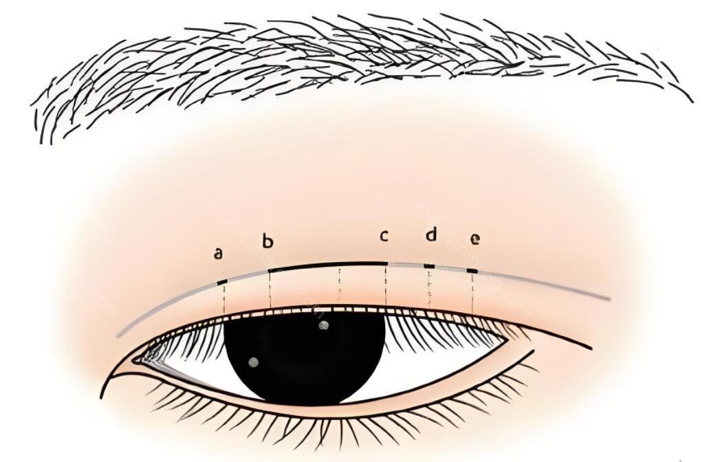 韩式三点式双眼皮手术过程：打造自然迷人的魅力眼眸