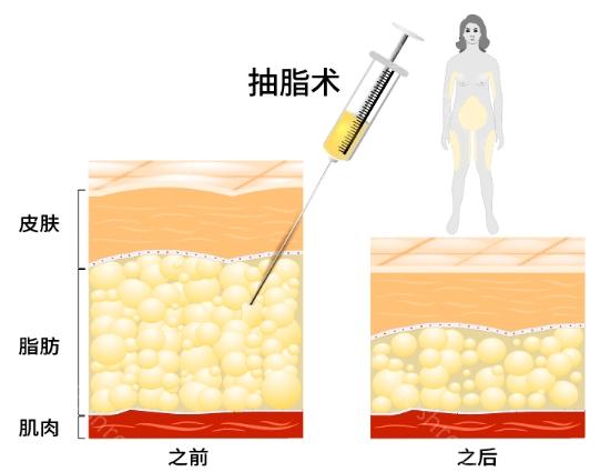 青岛诺美德吸脂技术可信吗?技术很好，而且吸脂收费也不贵