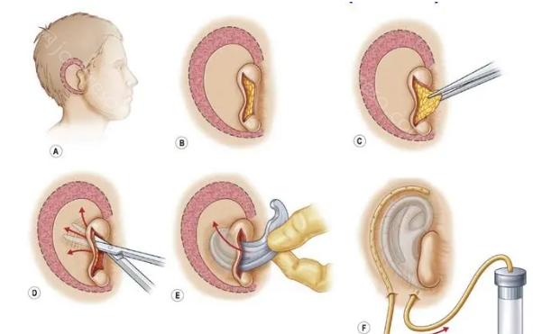 杯状耳畸形如何矫正?手术费用及效果解析