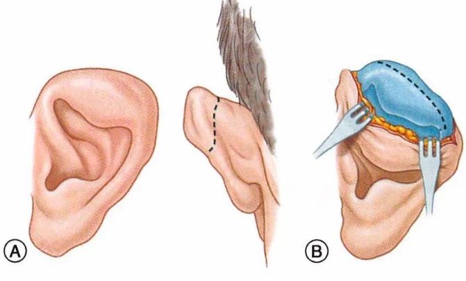 做耳再造多少钱一只?手术费用及治疗方案详解!