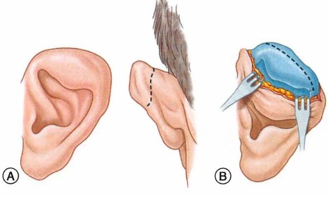 小耳畸形半包和全包有什么区别?过程，优缺点都不同