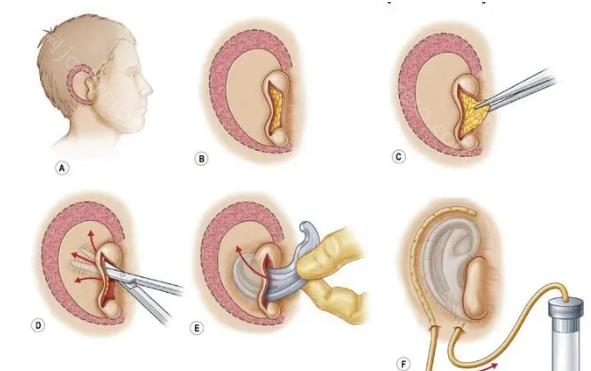 小耳畸形怎么治疗呢?小耳畸形矫正的最佳年龄是几岁?