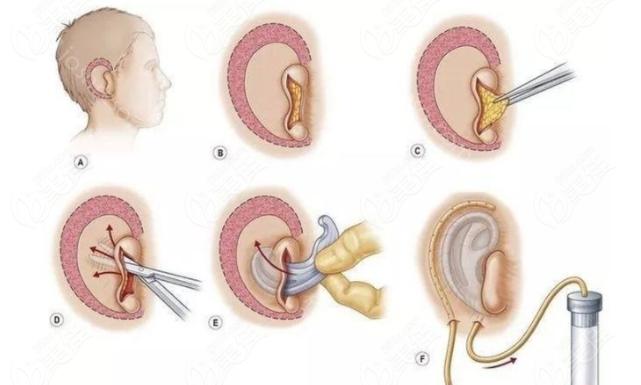 自体肋软骨耳再造对身体的影响大吗?耳再造的优势是啥?