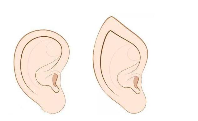 做小耳畸形矫正适合哪些情况?为什么要选择做小耳畸形矫正?