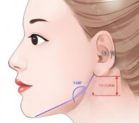 下颌角整形需要多少钱呢?矫正费用咨询更新-影响因素看这里