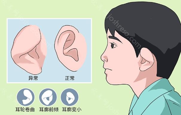 先天性小耳畸形怎么解决?具体的治疗方法及手术步骤解析