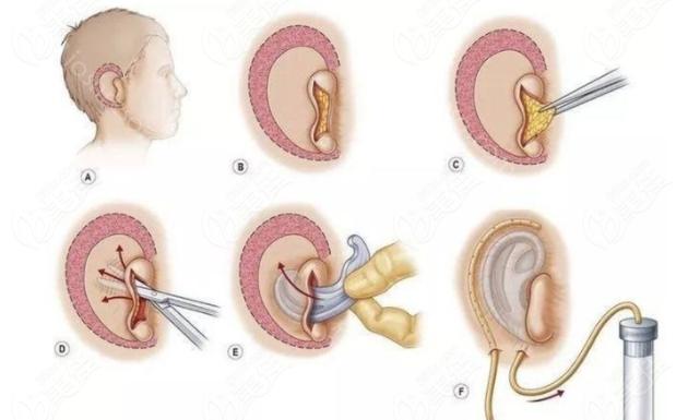 小耳再造具体步骤是啥?术后有什么需要注意的?