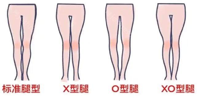 北京禾美嘉贺天遥芭蕾平行术咋样?做xo型腿很出色