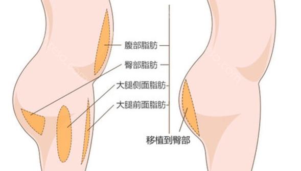 上海薇琳做自体脂肪丰臀好吗?技术很好，术后臀部饱满有型