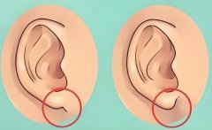 海南省人民医院整形科畸耳矫正手术费用与案例分享