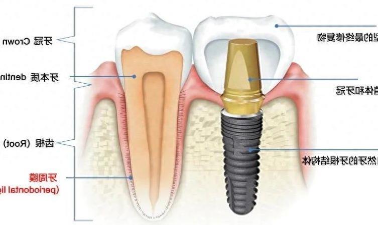 2024年种植牙技术解析：国产与韩国种植体的比较