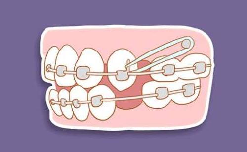 2024年牙齿矫正技术解析：普通与自锁托槽的比较