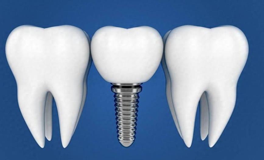 2024年种植牙新解：拔牙两年后是否还能进行牙齿种植？
