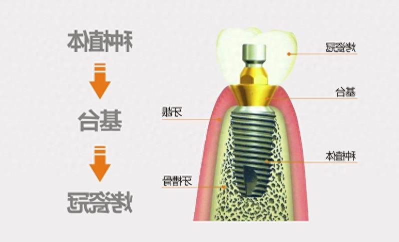 承德可米口腔诊所种植牙技术深度解析：宋国峰医师专业评价