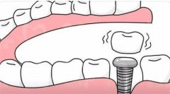 2024年牙冠脱落后能否重新固定？解析影响因素与修复策略