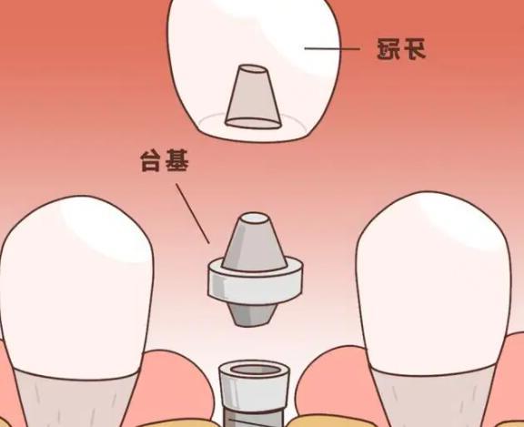 哈雷保持器的优缺点有哪些？请详细分析。