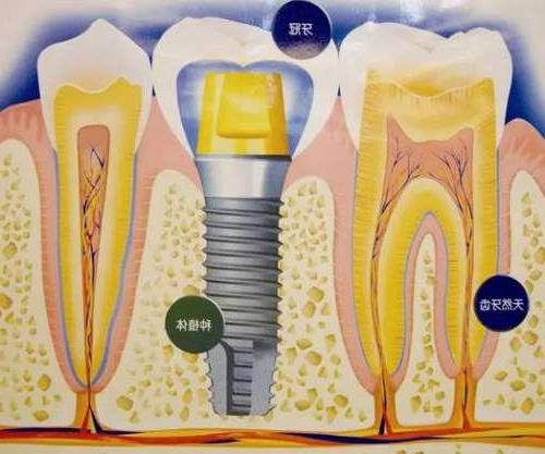 2024年北京劲松口腔医院种植牙服务深度解析