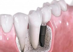 您对全口种植牙感到后悔吗？您了解全口种植牙的手术流程吗？