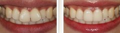 牙科做一颗全瓷牙修复需要多长时间呢