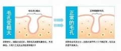 光子嫩肤治疗费用解析及效果预期