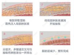 怎么样选择抽脂减肥，费用多少才合适？