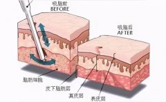 环形抽脂安全吗？效果如何？费用解析