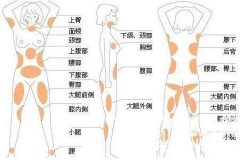 腰腹部抽脂术后疤痕情况如何？